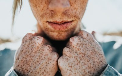 Prirodna pomoć kod hiperpigmentacije